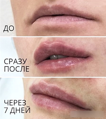 Увлажнение губ без увеличения гиалуроновой кислотой. Цена, фото