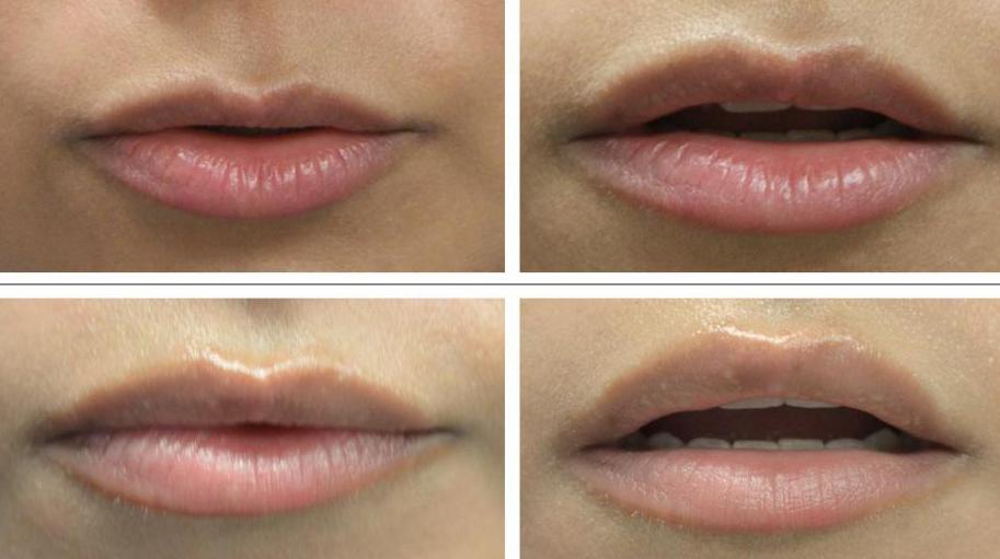 Препараты для увеличения губ: названия, рейтинг, выбор, индивидуальная переносимость и советы хирургов