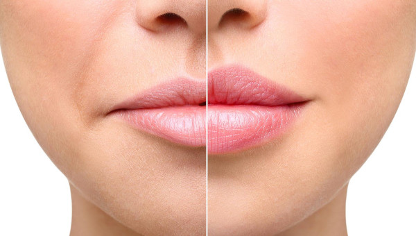 Асимметрия губ. Как исправить упражнениями, филлерами, татуажем