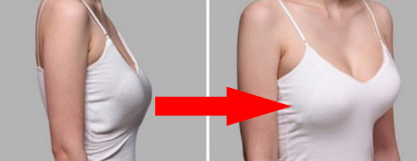 Туберозная деформация груди у женщин. Фото, как выглядит
