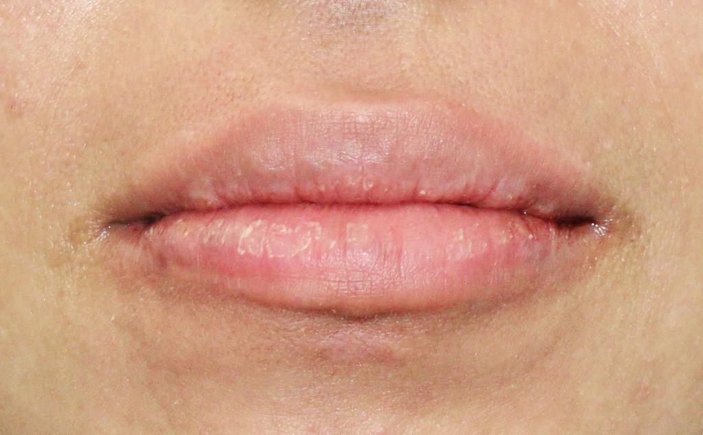 Неудачное увеличение губ: причины, последствия, исправление, отзывы