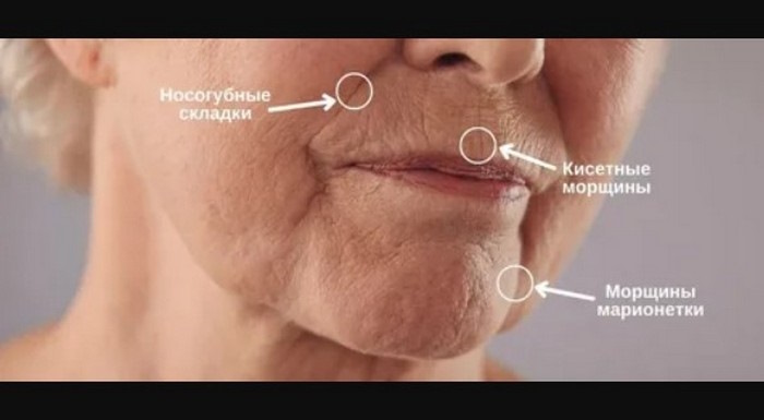 Морщины марионетки на лице около губ. Фото, как убрать