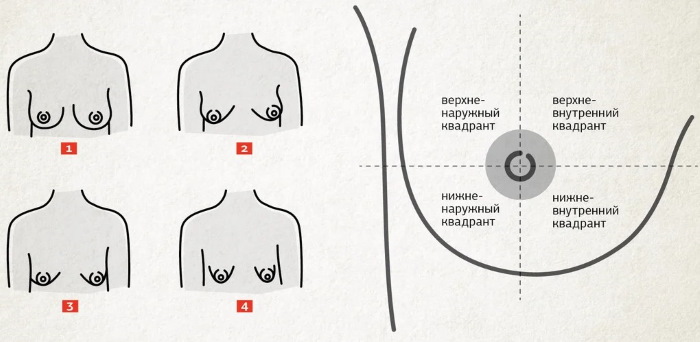 Тубулярная форма молочных желез, груди. Фото, коррекция без операции у женщин, мужчин