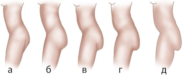 Птоз ягодиц. Фото до и после: упражнения, операция