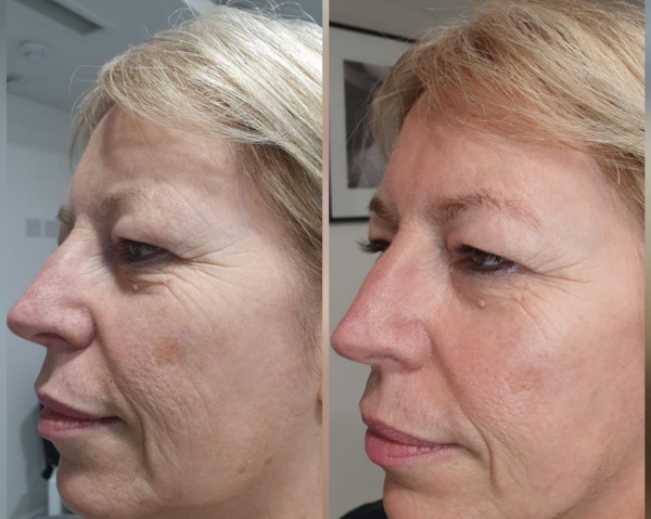 Ретиноловый пилинг (Retinol peeling) для лица. Эффект, фото до и после