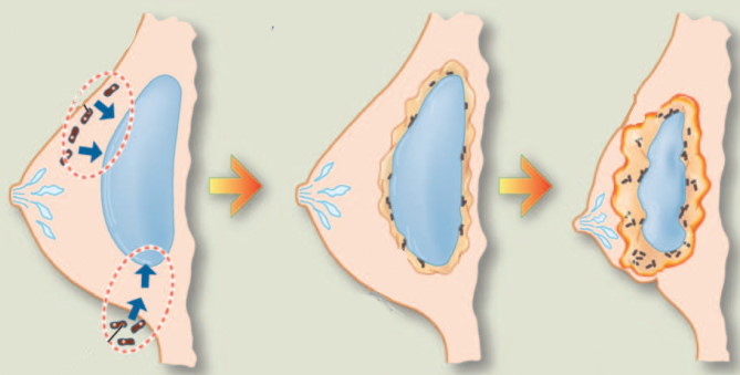 Грудные импланты: анатомические и круглые. Цена