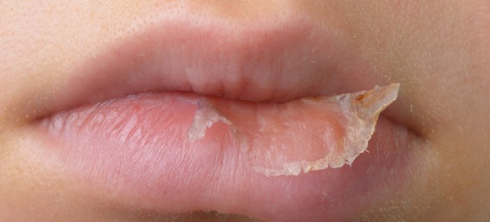 Шелушение губ: причины и лечение в домашних условиях
