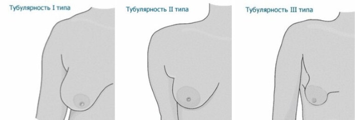 Тубулярная форма молочных желез, груди. Фото, коррекция без операции у женщин, мужчин