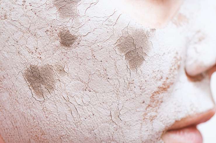 В сухом остатке: как справиться с шелушением
